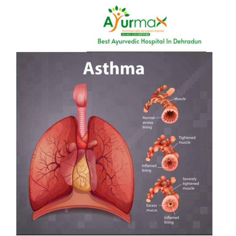 What are the latest advancements in asthma treatment?